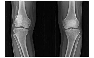 Major Differences Between Bow Legs and Knock Knees in Children