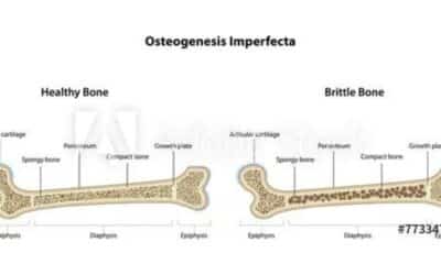 Osteogenesis Imperfecta in Children: Impairment and Disability