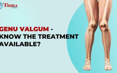 Knock Knees (Genu Valgum) -Treatment