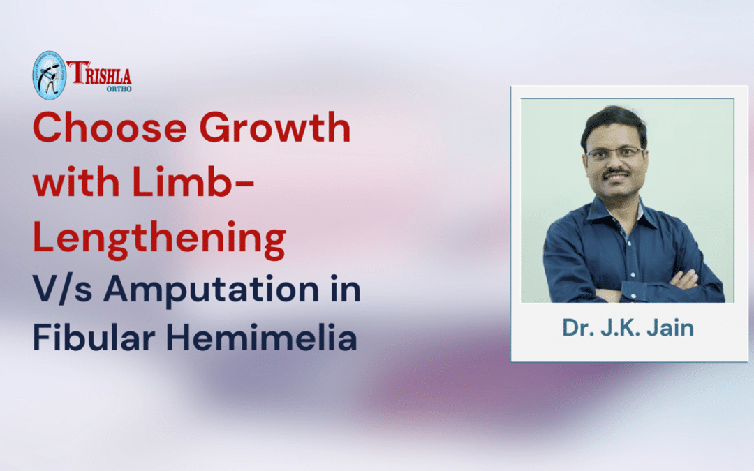 Choose Growth with Limb-Lengthening versus Amputation in Fibular Hemimelia